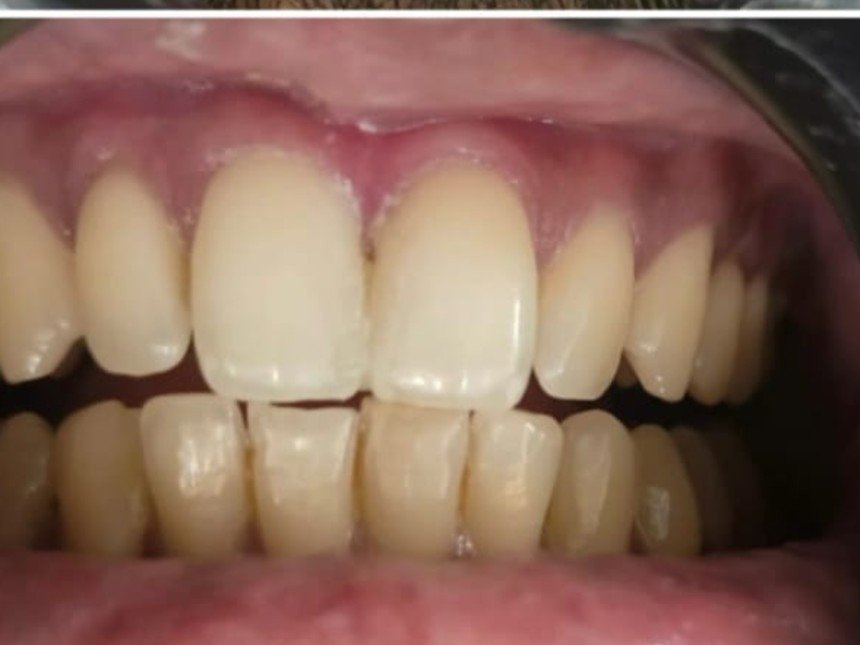 Case 4 after treatment at Dental Fit