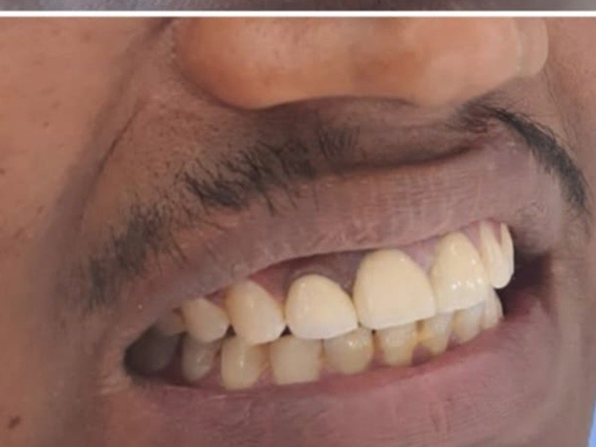 Case 1 after treatment at Dental Fit